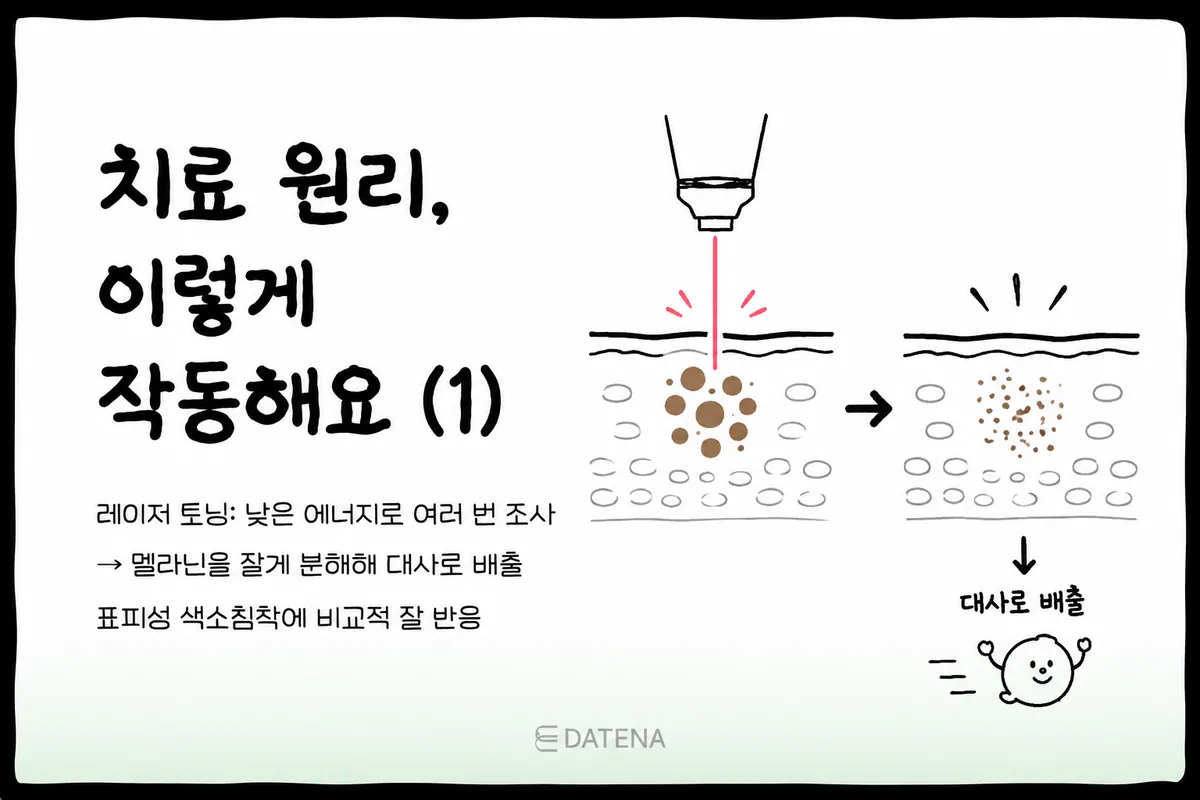 레이저 토닝은 낮은 에너지를 반복적으로 조사해 멜라닌 색소를 잘게 분해하는 데 도움을 줍니다. 분해된 색소는 피부의 대사 과정을 거쳐 서서히 배출됩니다.