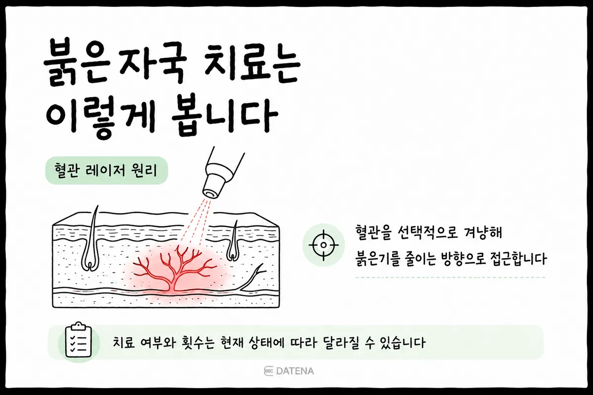 여드름 붉은자국의 확장된 혈관을 대상으로 하는 혈관 레이저 원리 그림