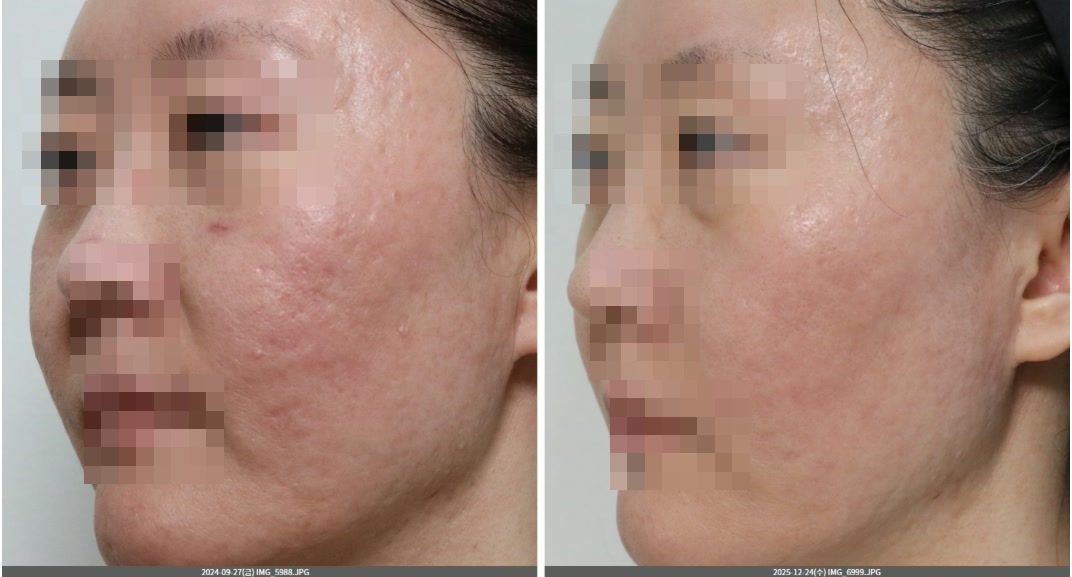 살결테라피 인텐시브 6회 전후