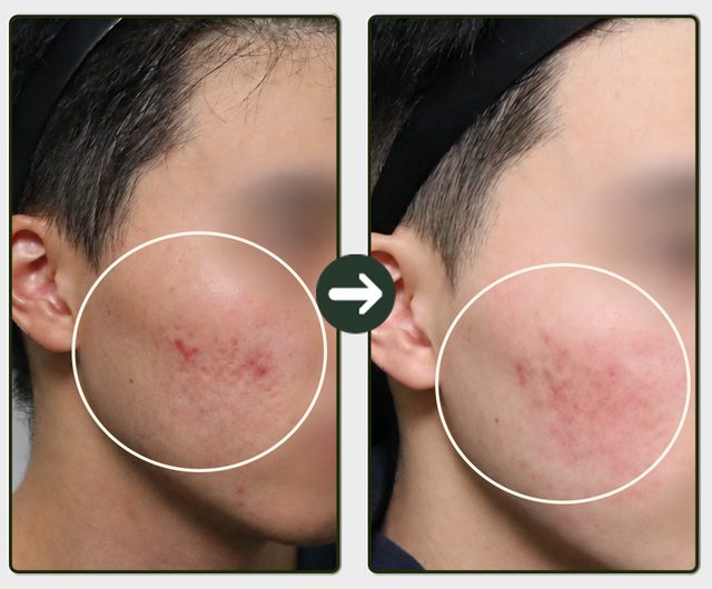 살결테라피 전후 사례 9
