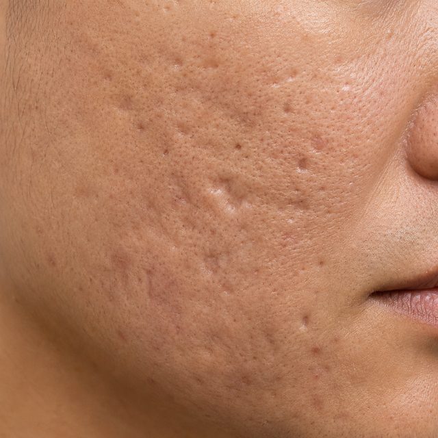 복합형 흉터 예시